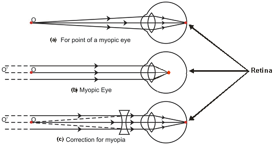 defect of vision in human eye pdf
